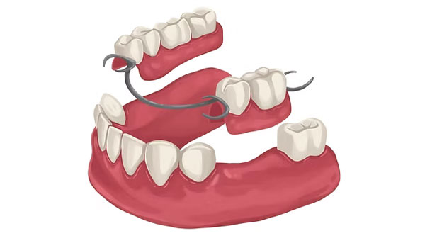 Partial Denture